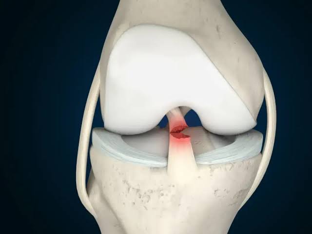 Crucial Ligament tear ventral