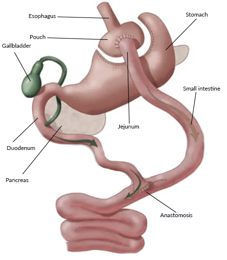 Roux-en-Y Gastric Bypass